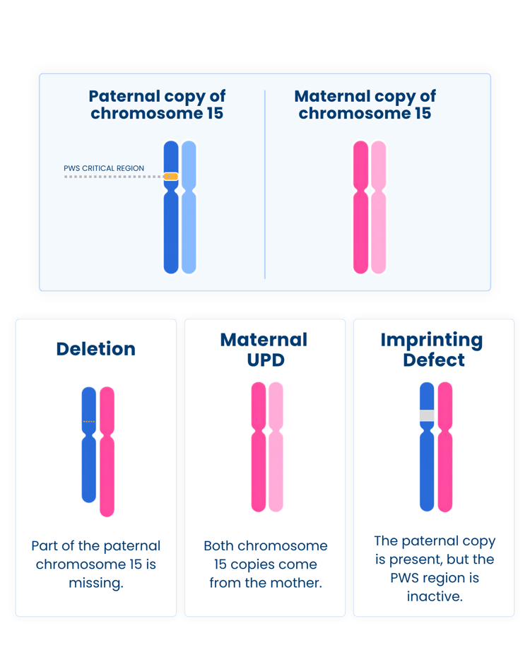 Diagram showing three genetic causes of Prader-Willi syndrome: paternal chromosome 15 deletion, maternal uniparental disomy (UPD), and an imprinting defect.