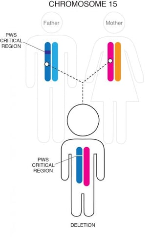 Small hands characteristic of Prader-Willi syndrome.