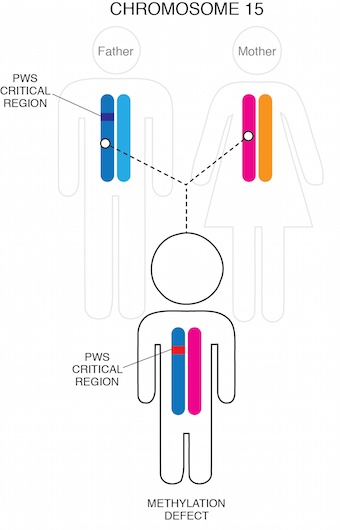 Diagram of PWS by imprinting mutation chromosome 15