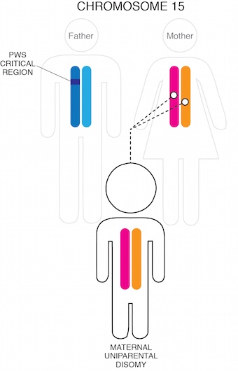 Diagram of PWS by UPD chromosome 15