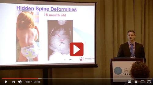 van-bosse-orthopedics-scoliosis-and-pws-presentation.jpg