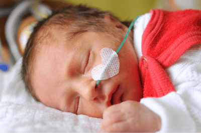 NG feeding tube