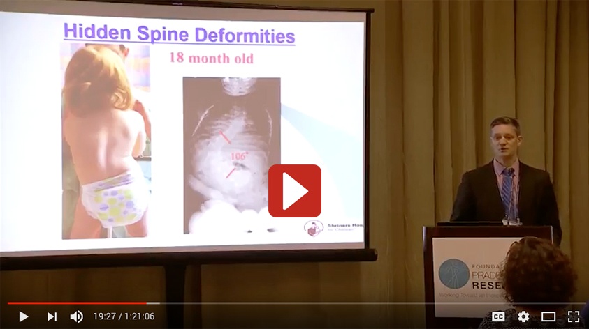 van-bosse-orthopedics-scoliosis-and-pws-presentation-6